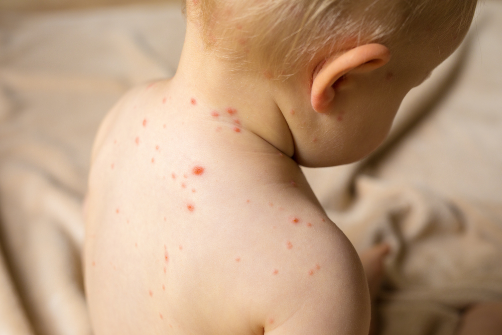 Got Chickenpox? Oats Will Save Your Sanity!