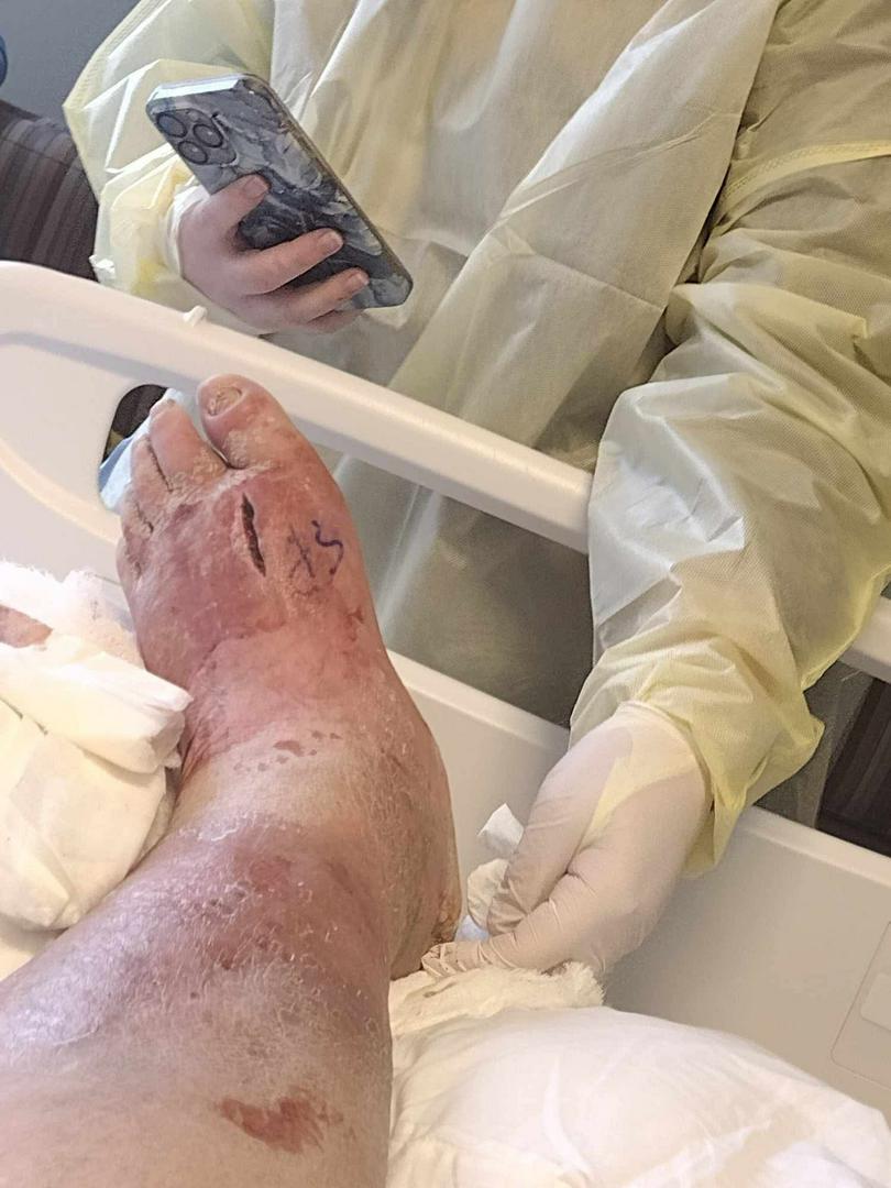 I almost lost my foot last year