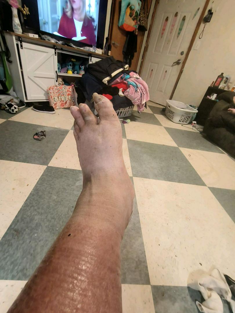 I almost lost my foot last year