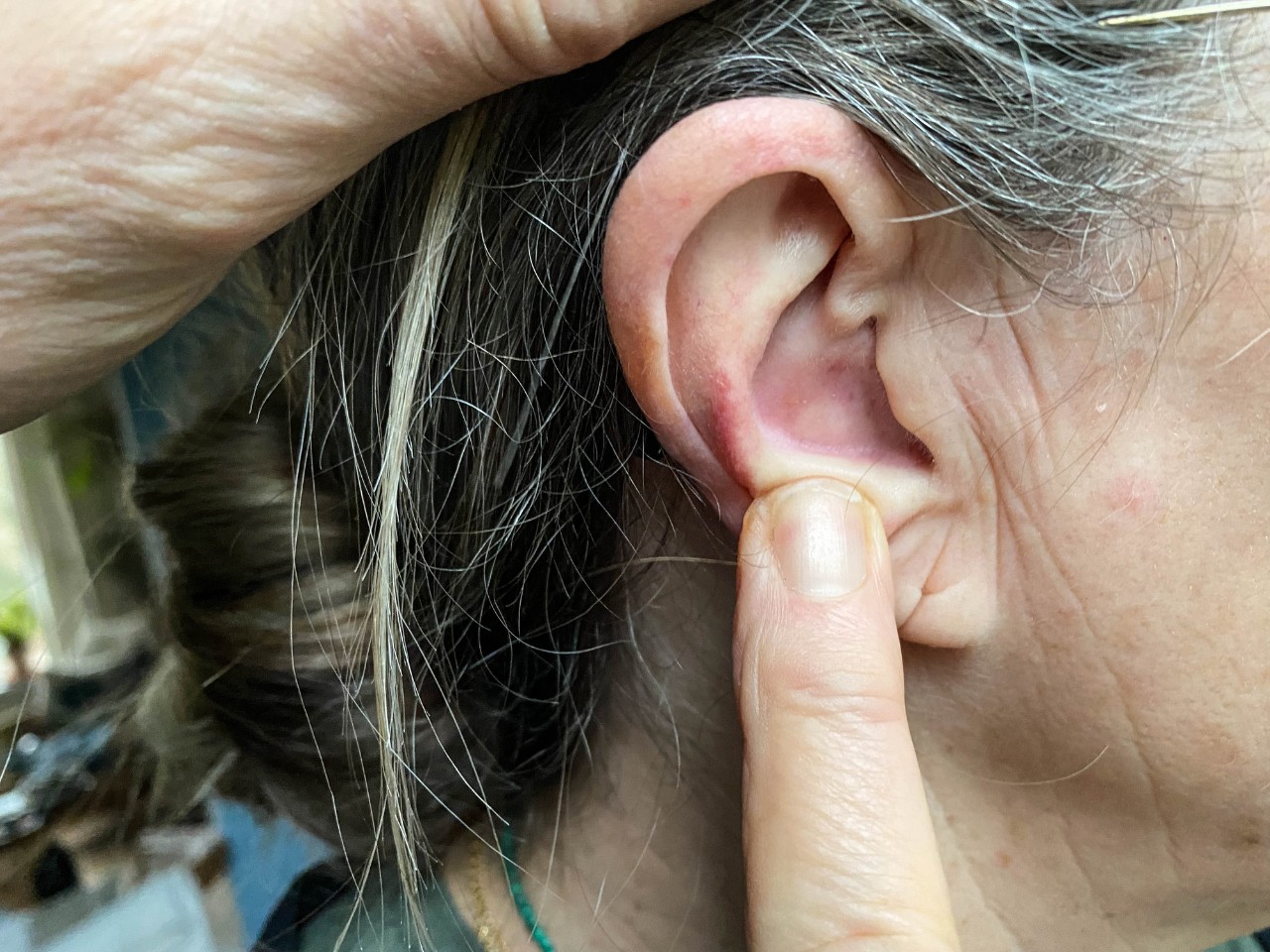 Weird Bumps Behind My Ear—Anyone Else?