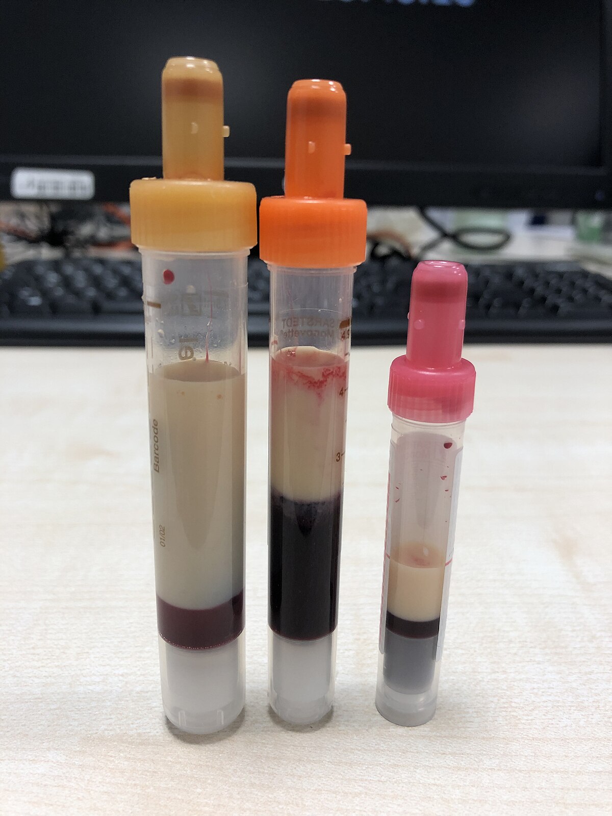 Anyone Dealt With High Triglycerides Like This?