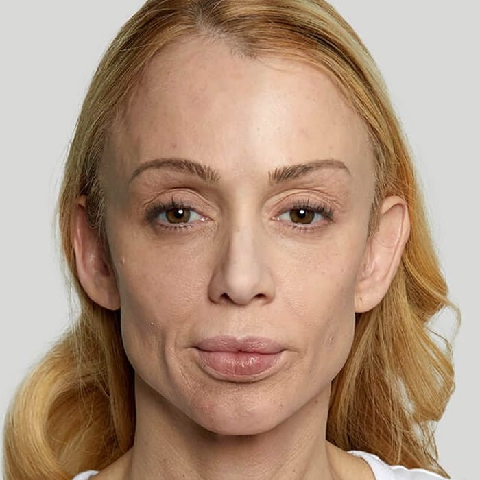 Are These Cheekbone Dents Just Genetics or Can I Smooth Them Out?