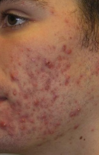After Decades of Acne, My Dermatologist Said I Look 20—Is This Real Life?