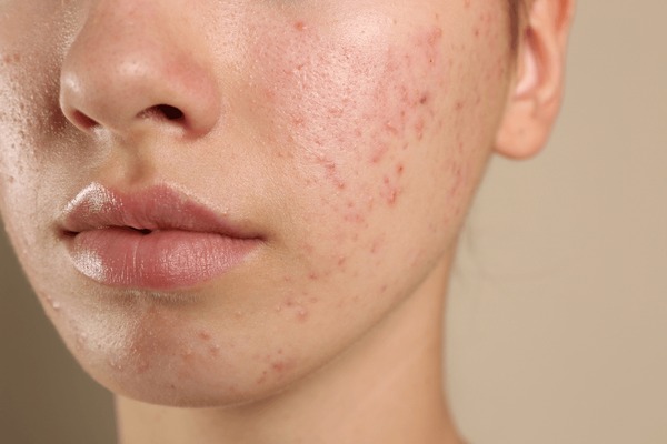 Why Does My Skin Betray Me Right Before Big Events?