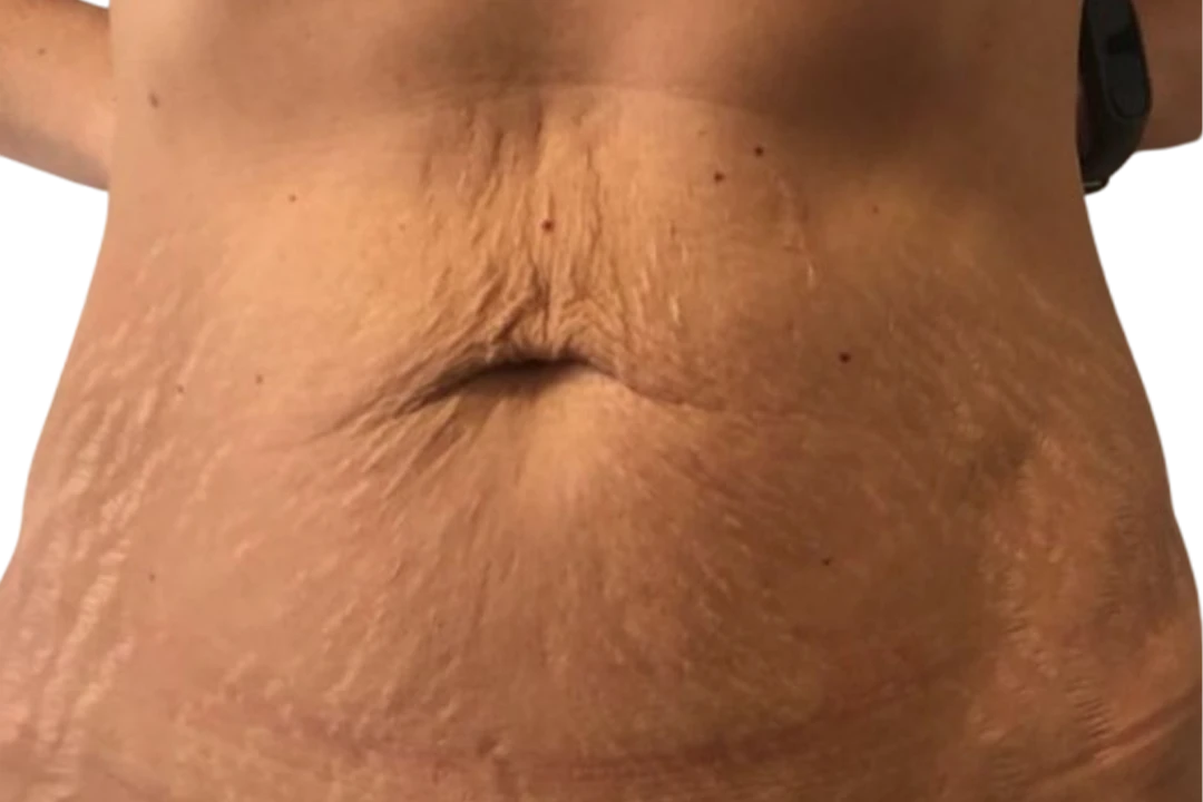 Stretch Marks: What Actually Works (and What’s Just Hype)