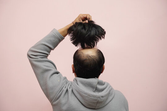 My Husband Fears I’ll Leave Him for Balding—But I’m Bald! 😂🤦‍♀️