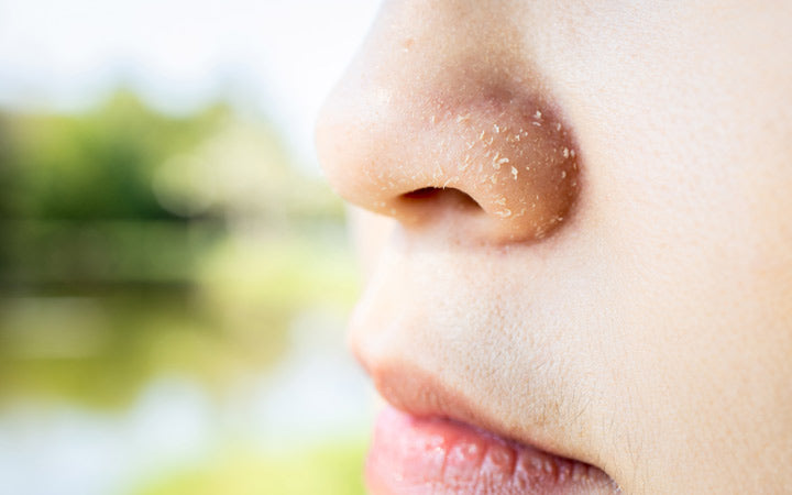What No One Tells You About Beating Dry, Flaky Skin Around Your Nose
