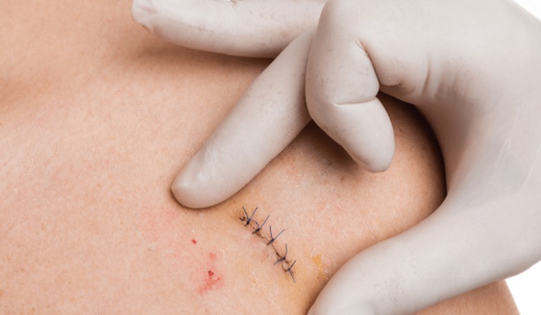 Ever Had a Punch Biopsy?