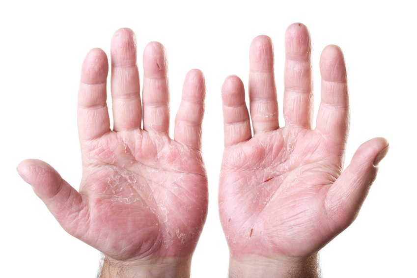 My Secret Fixes for Stubborn Hand Eczema