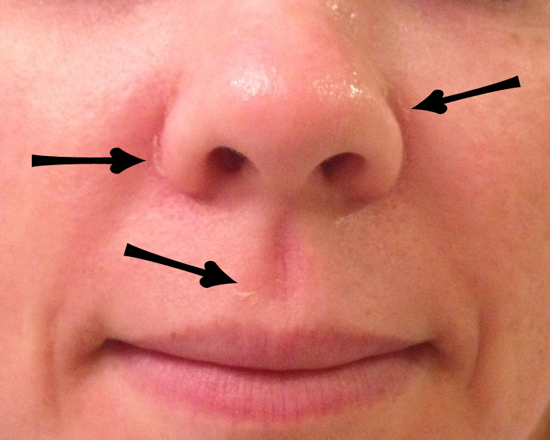 Anyone else get mouth rashes from dust?