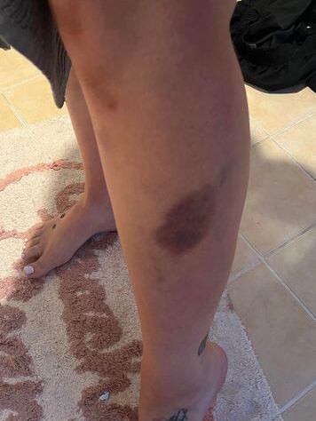 Those Random Bruises? Not So Random