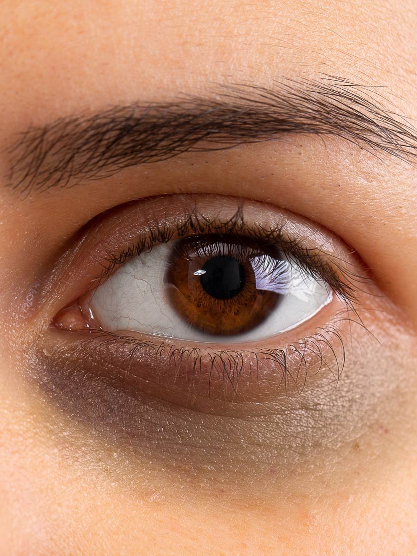 Anyone else dealing with dark circles?