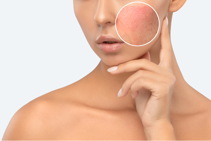 Face Hives? How I Calm the Chaos (and Avoid a Makeup Meltdown!)
