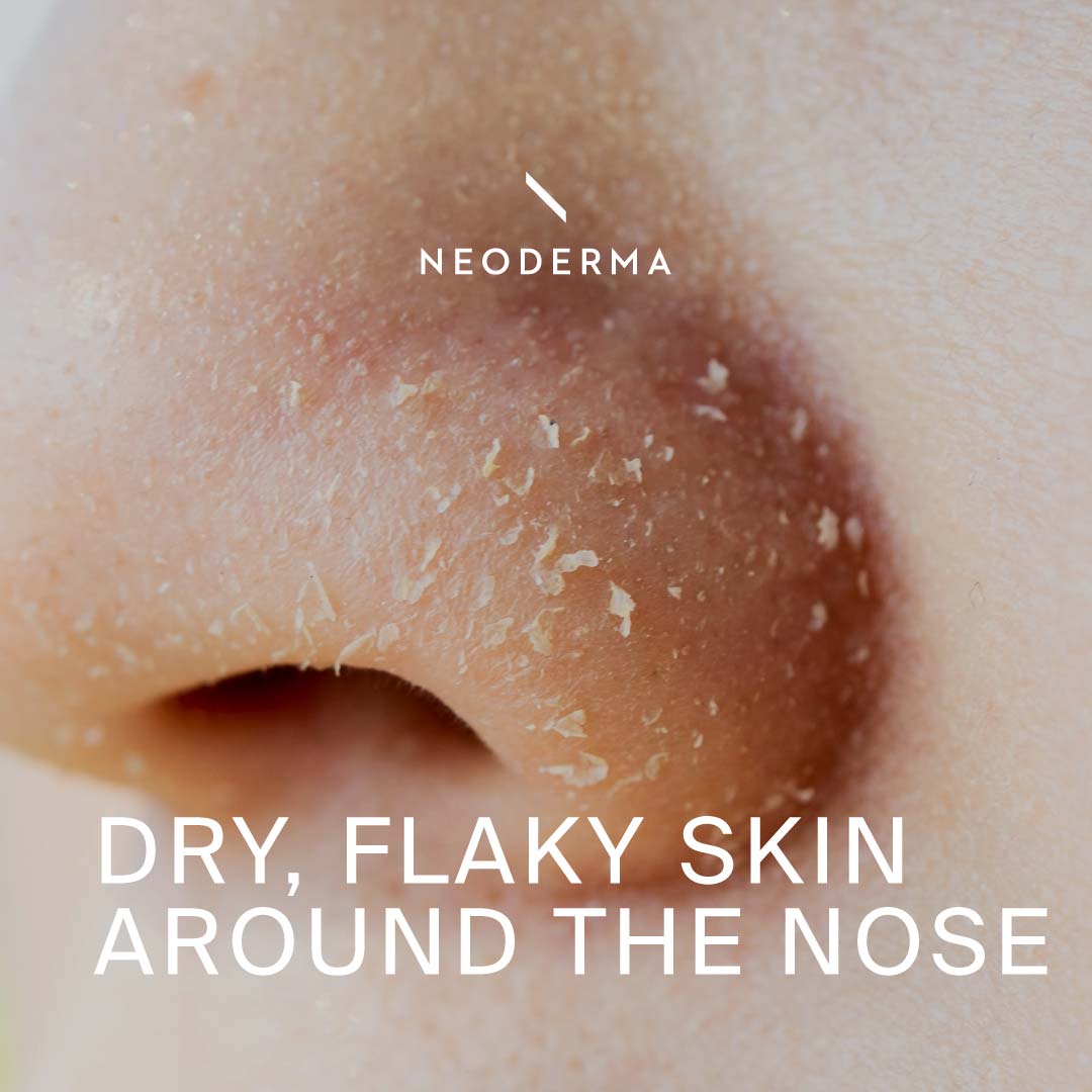 Say Goodbye to Flaky Nose Days: My Dry Skin Fixes That Actually Work!