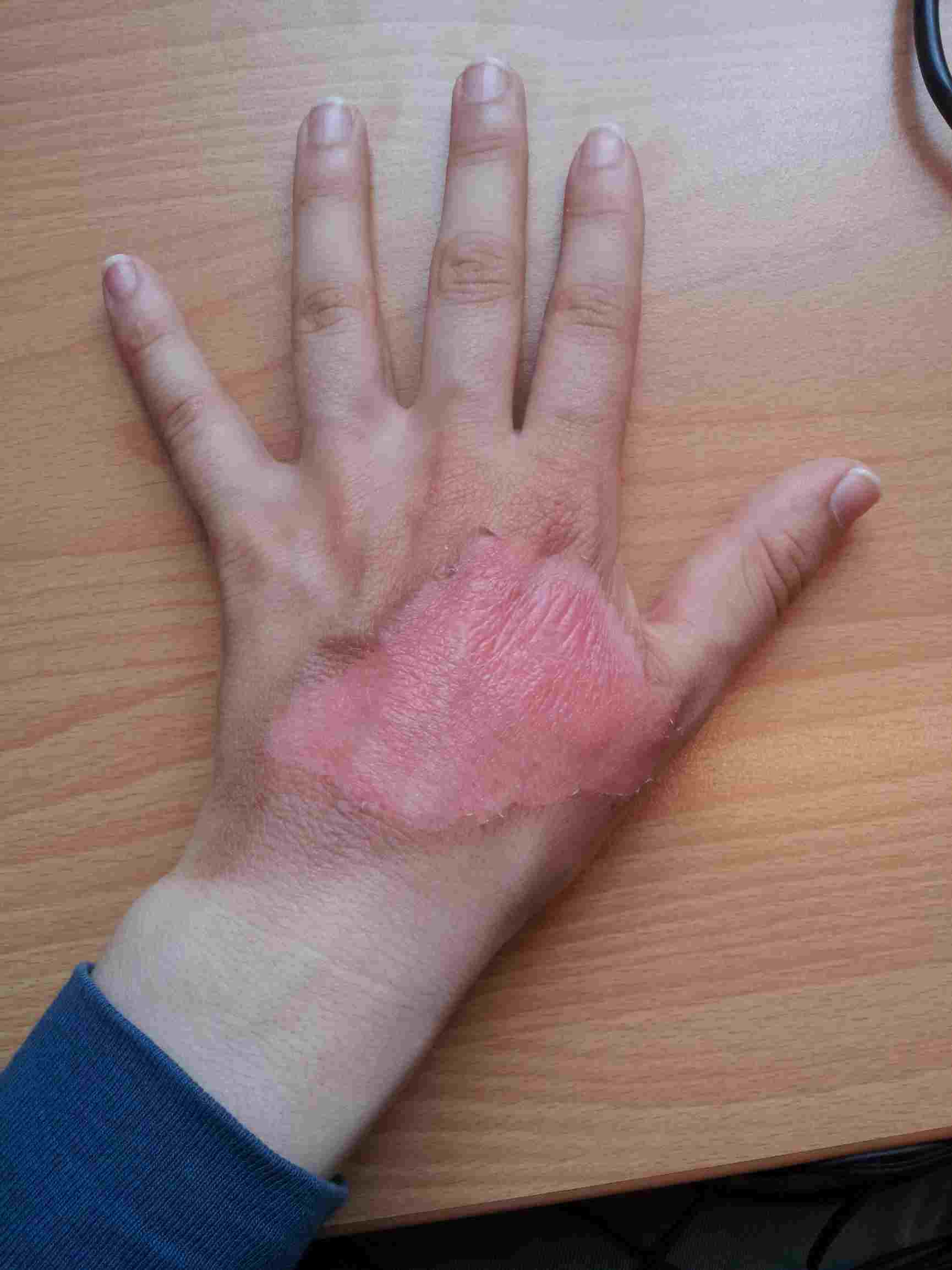 Burned by Soup and His Cold Heart—Literally!