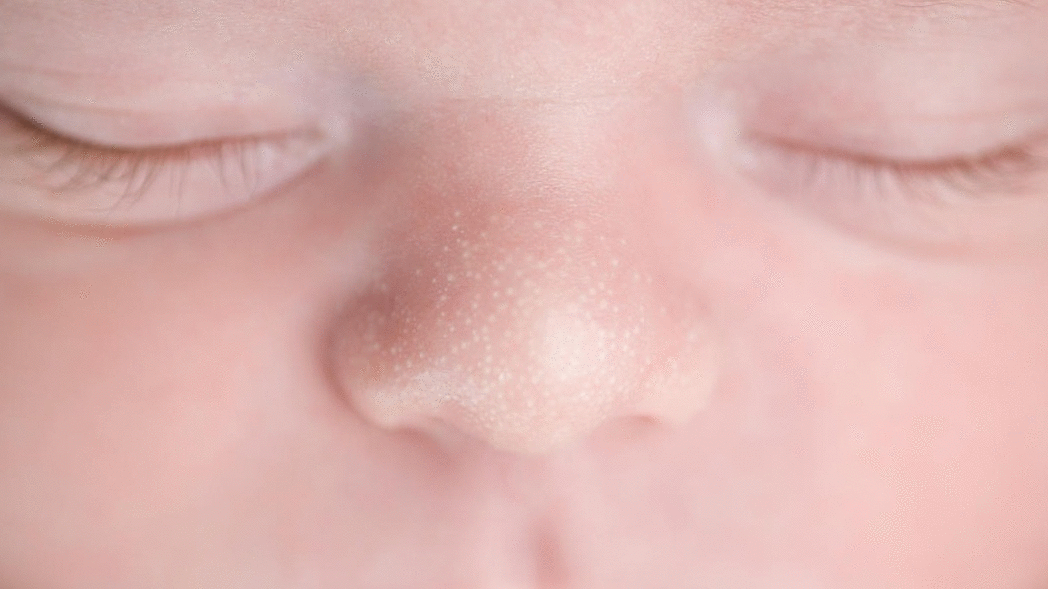 Millia on Little Ones: Gentle Solutions or Just Wait It Out?