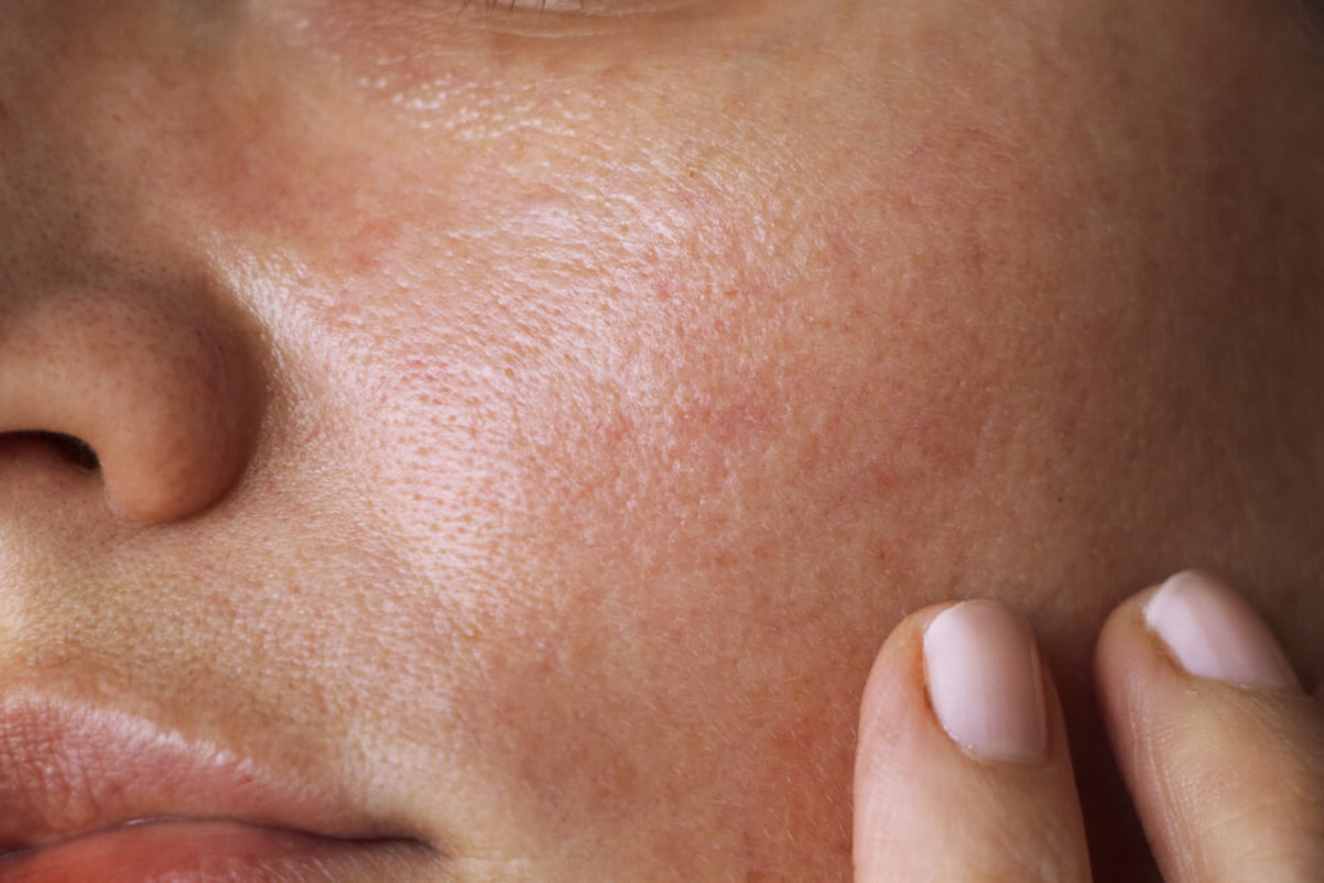 Oily Yet Parched: Why Won’t My Skin Pick a Side?