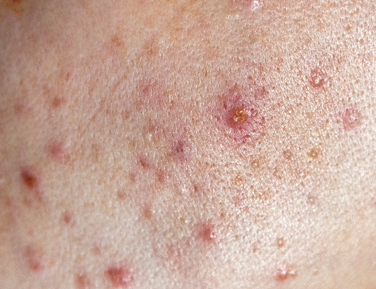 Will My Skin Ever Catch a Break? The Tretinoin Rollercoaster
