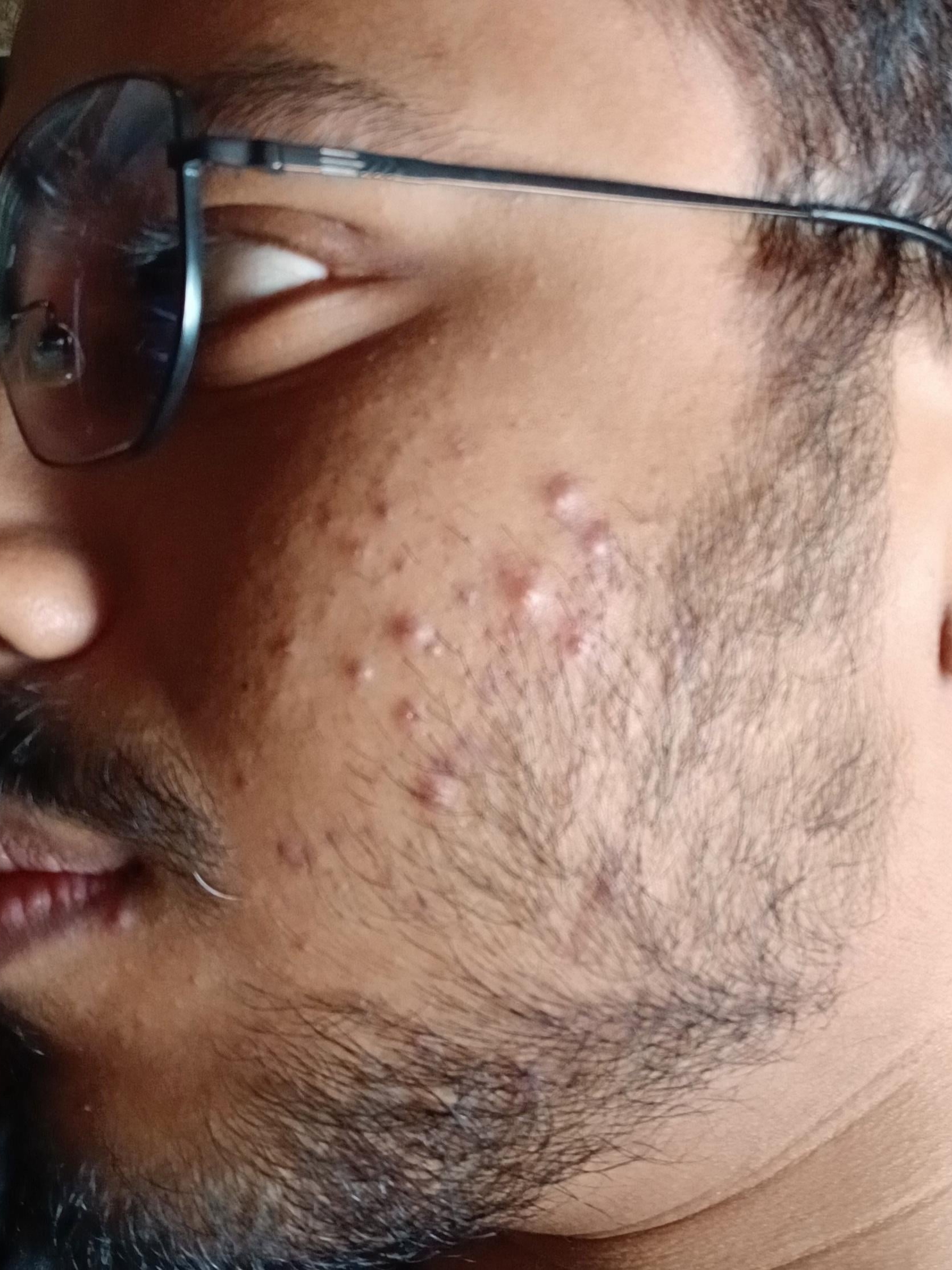 Why Does Acne Always Show Up Right Before Big Events?