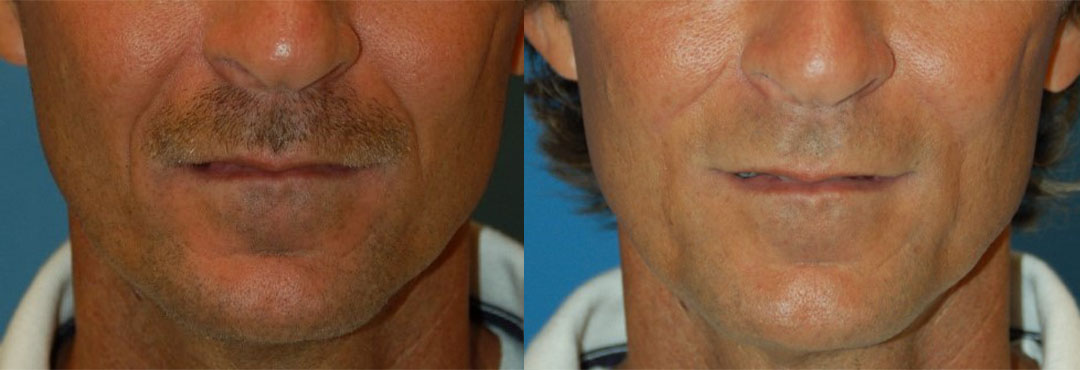 Can Sleeping on Your Back Really Soften Nasolabial Folds? My Surprising Update
