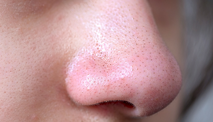Pores Shrinking, But Now I See All the Nose Fuzz—Help!