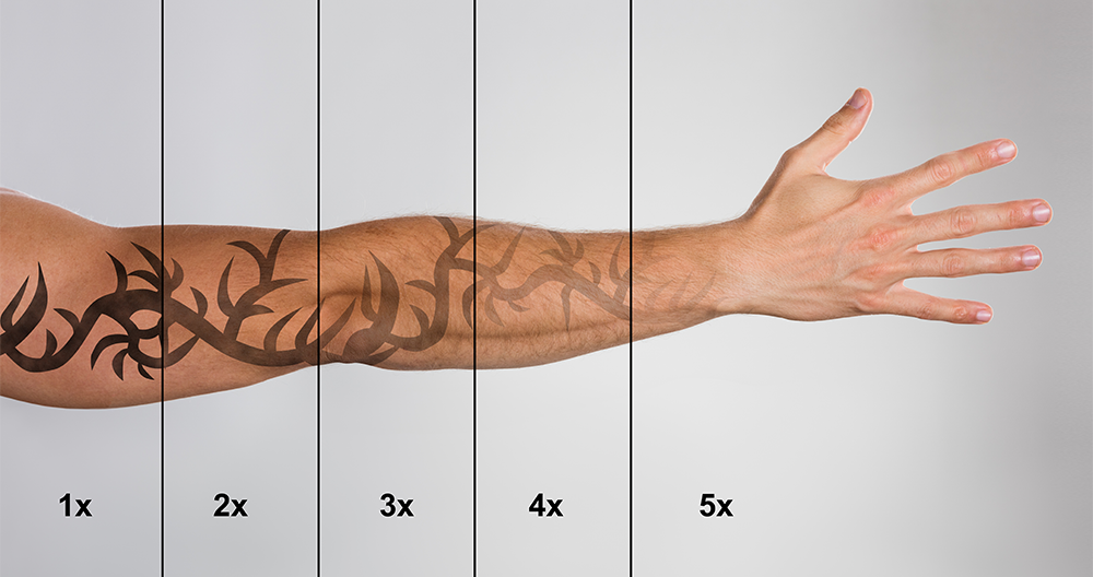 Ready to Break Up With Your Tattoo? Here’s What Actually Happens