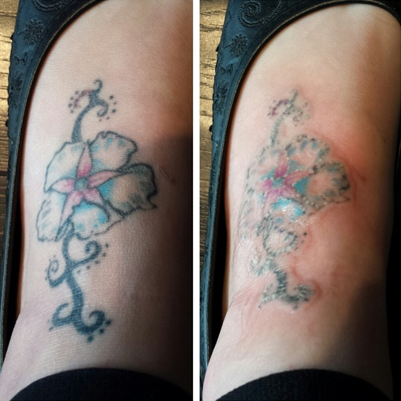 Ready to Break Up With Your Tattoo? Here’s What Actually Happens