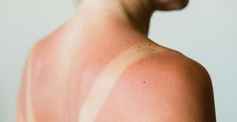 Is Once-a-Day SPF Enough? My Accidental Sunburn Experiment Says YES!