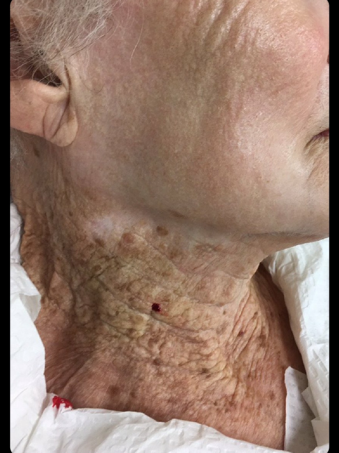 Face vs. Neck: The Sun Damage We Never Saw Coming