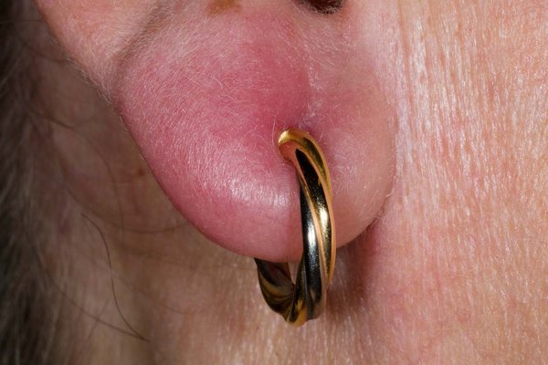 My Piercing Got Infected and So Did My Confidence