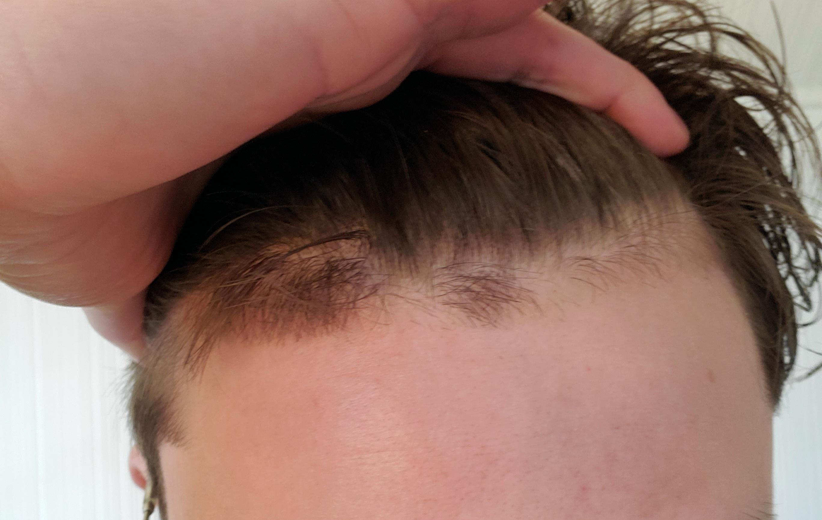 My Hairline Is Never Straight Enough
