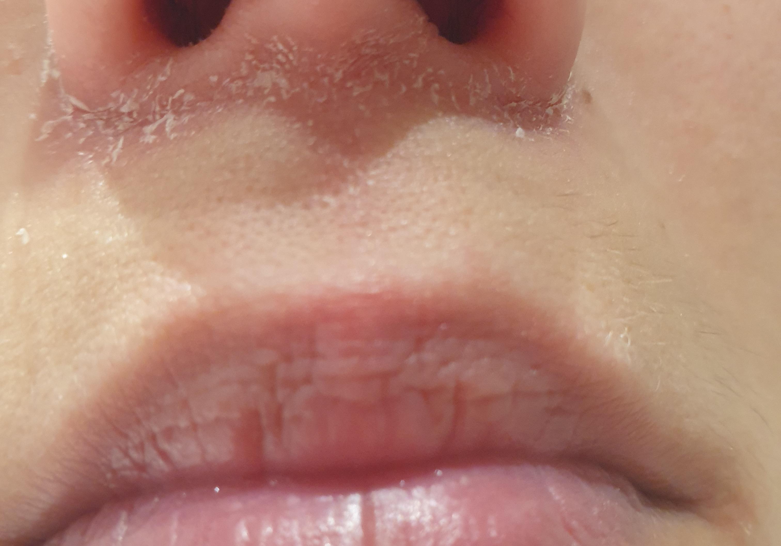 My Nose Peels Before My Confidence Does