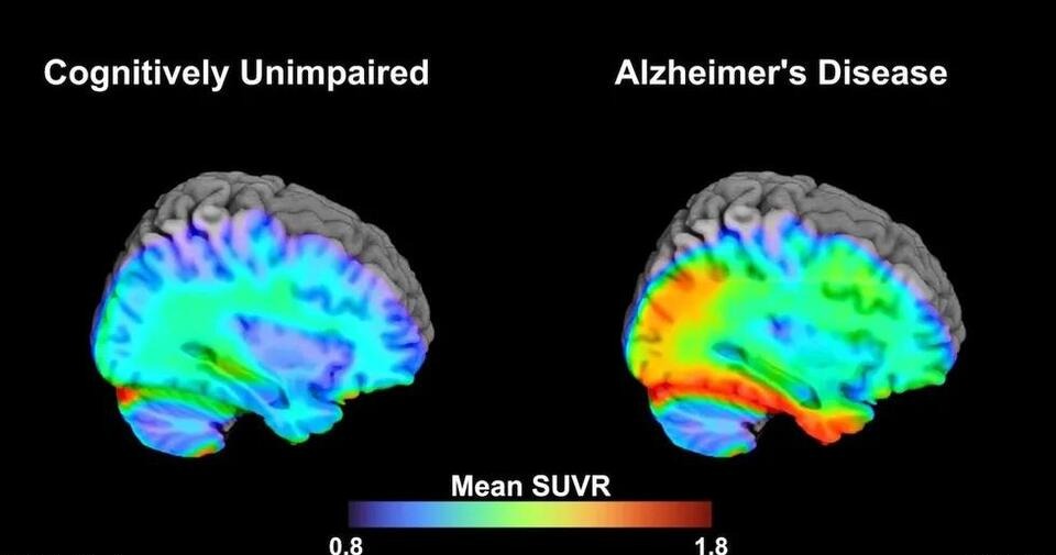 New Brain Scan Could Spot Alzheimer’s Early