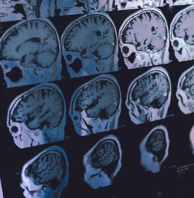 This MRI Can Predict Your Brain’s Future