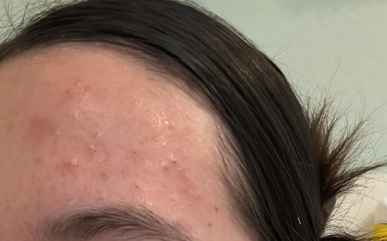 HELP. Is my skin purging or breaking out? Anua cleansing oil and deep pore cleanser