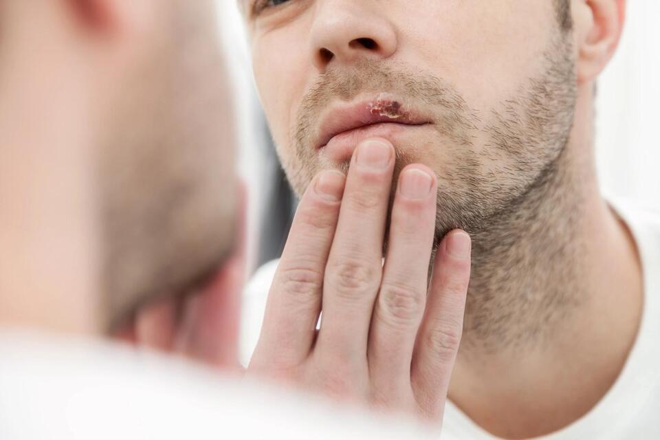 Herpes: The Unexpected Cancer Fighter?!