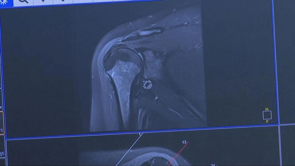 Frozen Shoulder Strikes Again?