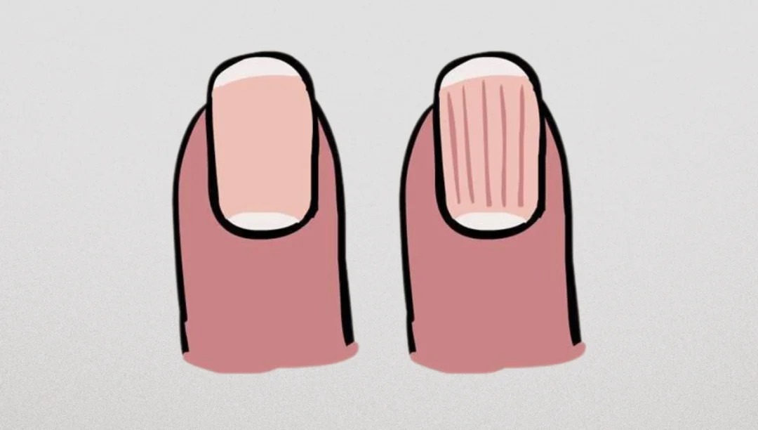 Do you have these vertical lines on your nails?