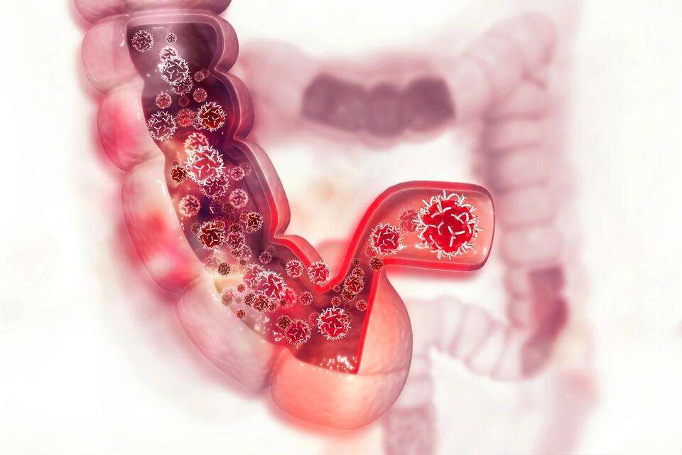 Colon Cancer Risk Doubles for Millennials?!