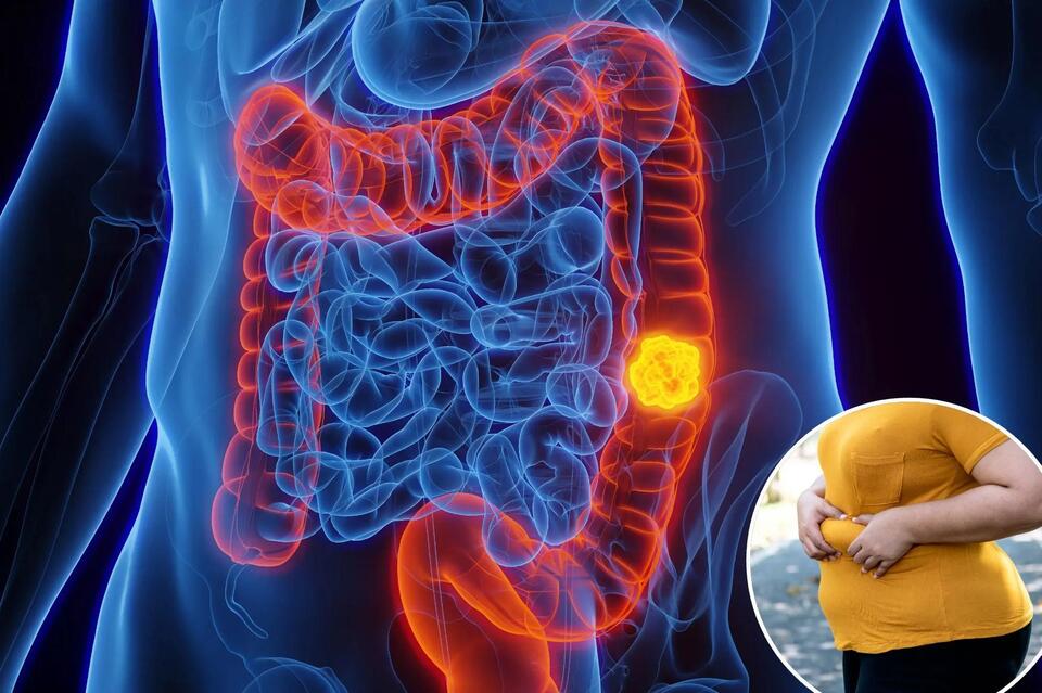 Colon Cancer Risk Doubles for Millennials?!