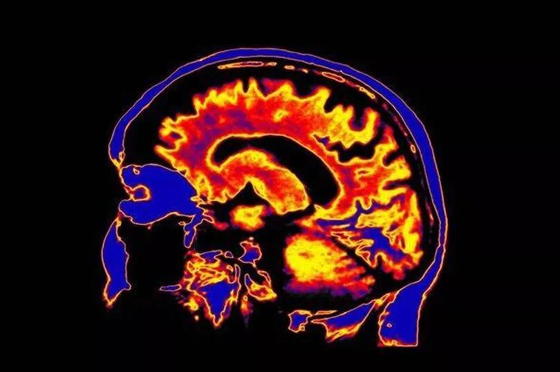Cut Your Dementia Risk—It’s Easier Than You Think!