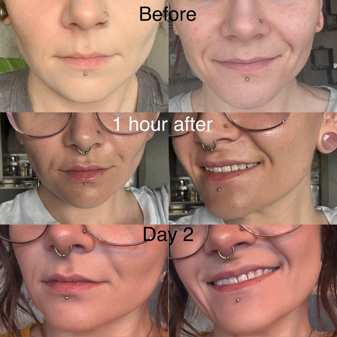 You can barely tell she got anything. Is this lip filler a SCAM? 🤨