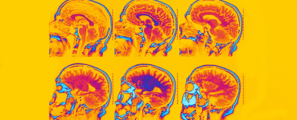 Vaccines & Dementia: Surprising Link!