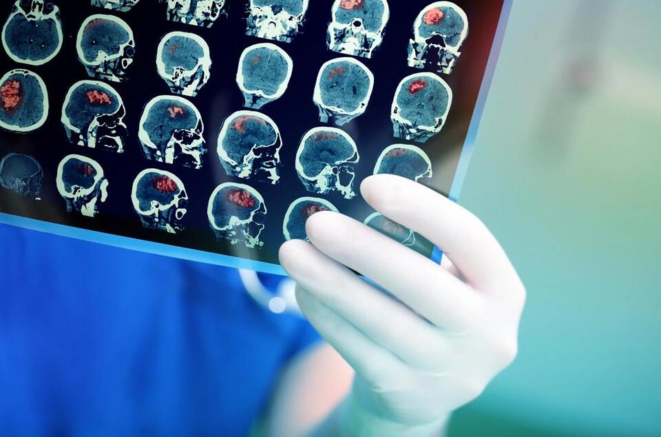Your REM Sleep Might Reveal Alzheimer’s Risk
