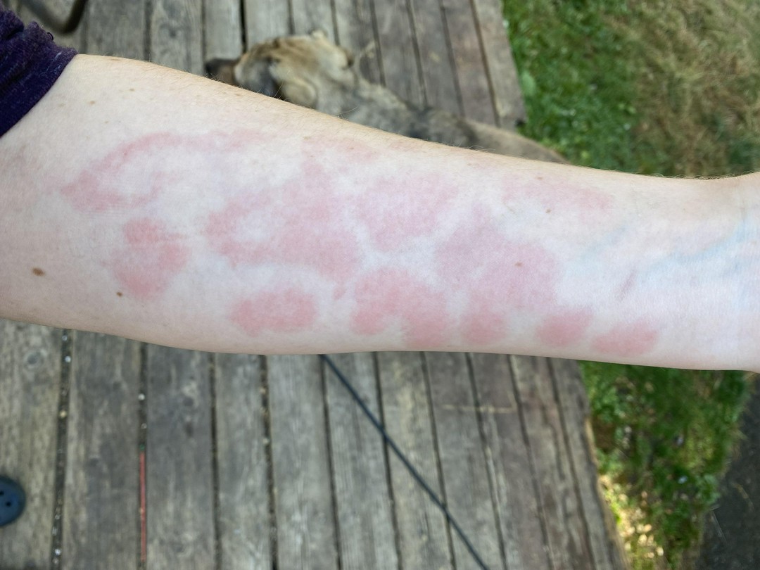 The rash kinda looks like animal print 😦