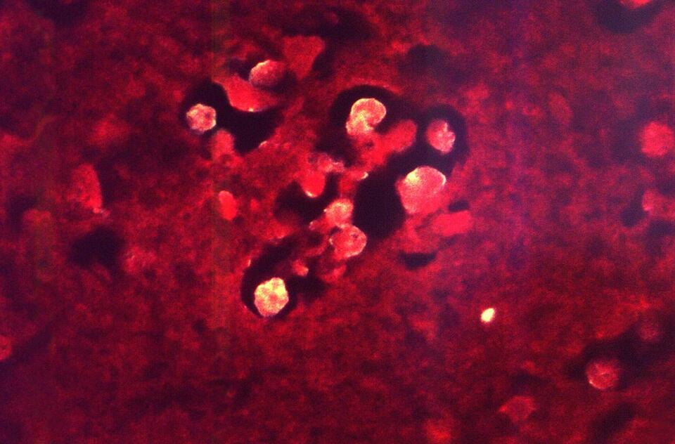 Brain-Eating Amoeba Alert at Lake Murray?!
