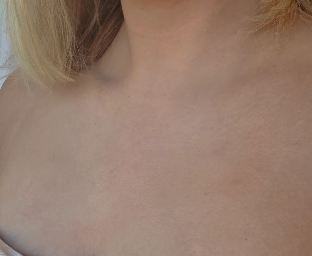 The skin after 3 months of hormonal birth control vs. What it was since 2019 (35, female) 😦😱