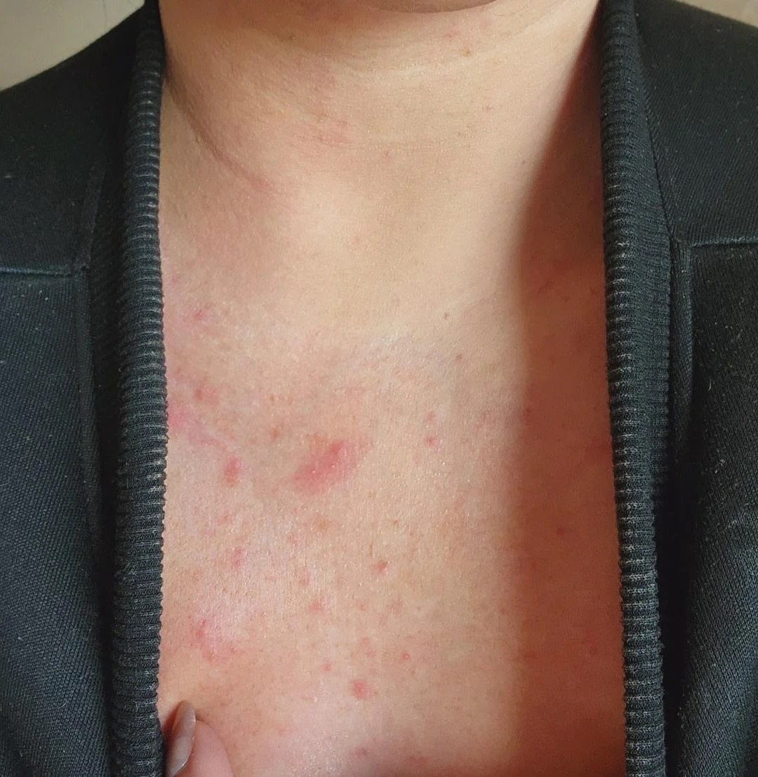The skin after 3 months of hormonal birth control vs. What it was since 2019 (35, female) 😦😱