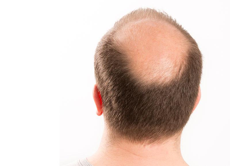 Can we all agree that when it gets this bad we should just shave our heads?