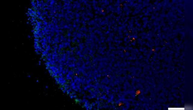 COVID Brain Fog = Alzheimer’s in Disguise?